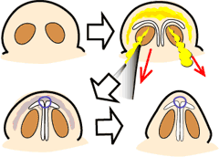 鼻翼縮小の図解